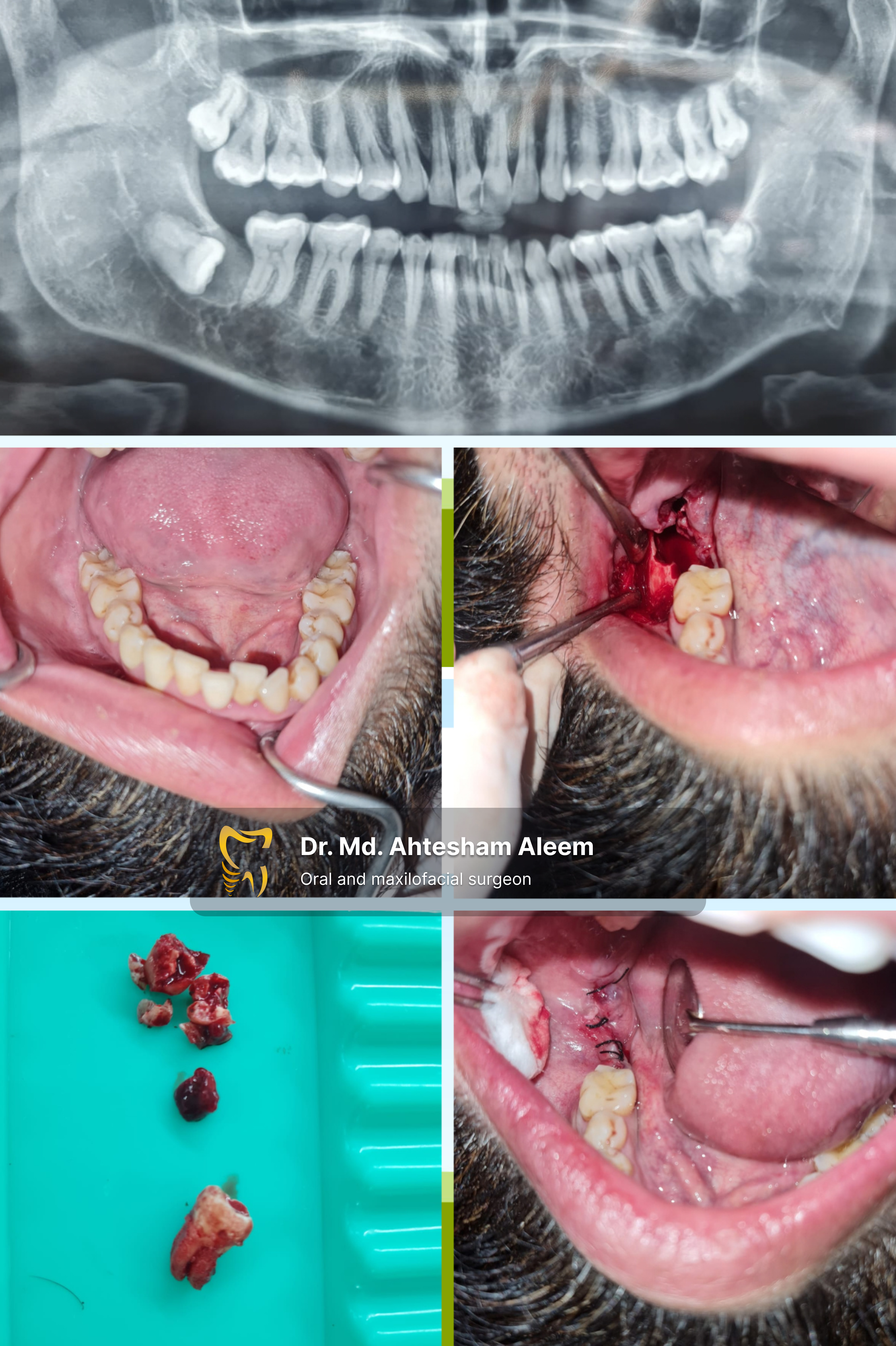 Jaw Cyst Surgery Image 1